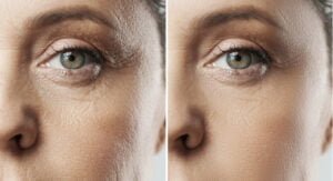 Facelift energetico - rejuvenecimiento facial